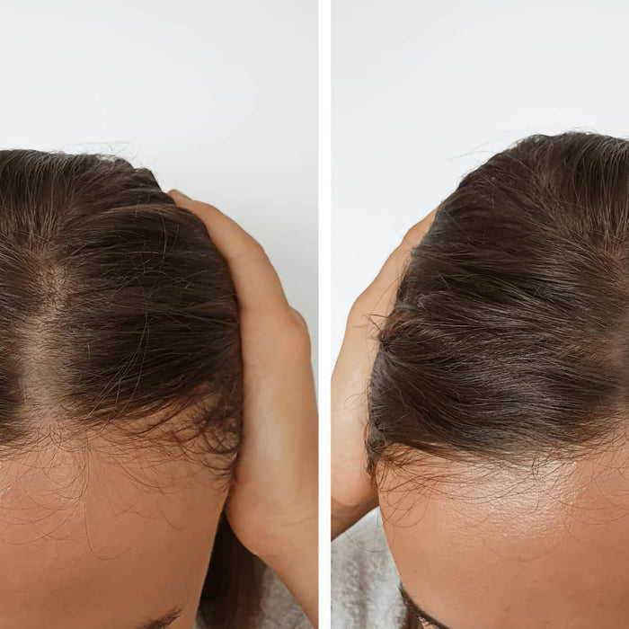 Hyperbaric Oxygen Therapy for Hair Growth