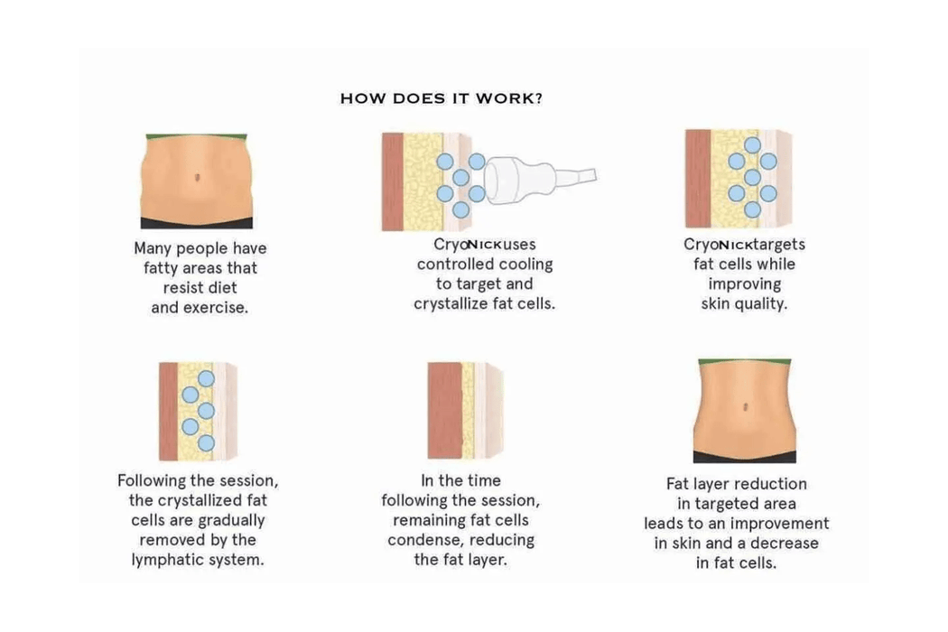 VACUACTIVUS Iceberg Cryonick Roller Mini Coolsculpting Machine