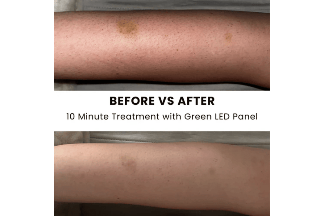 Before and after using Lumara Illuminate Green Professional Green Light Therapy Panel