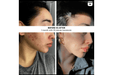 before and after for Lumara VISO Professional Red Light Therapy Mask