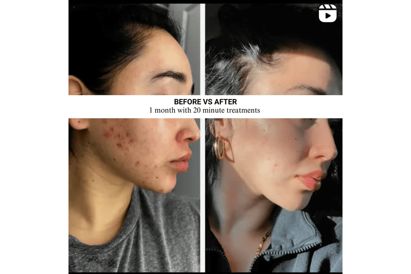 before and after for Lumara VISO Professional Red Light Therapy Mask