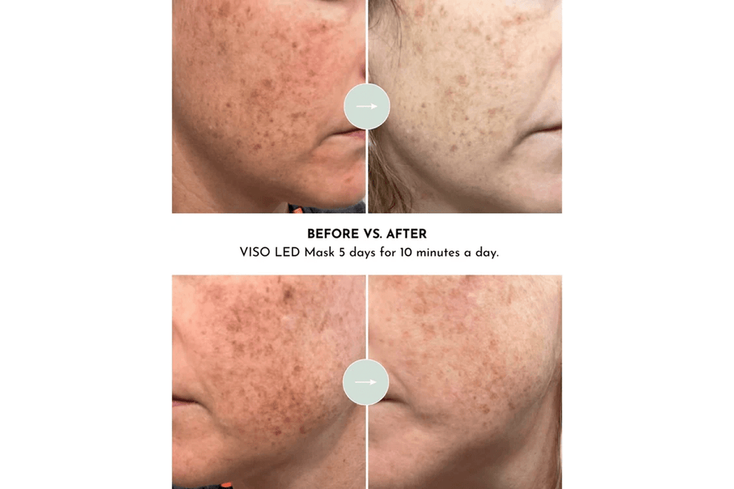 before and after for Lumara VISO Professional Red Light Therapy Mask for 10 minutes a day
