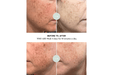 before and after for Lumara VISO Professional Red Light Therapy Mask for 10 minutes a day