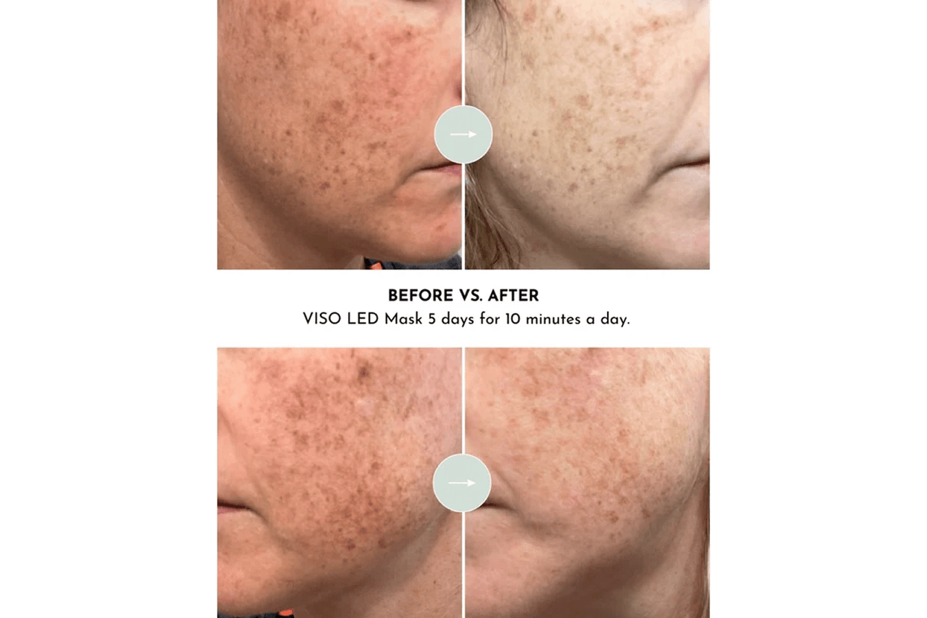 before and after for Lumara VISO Professional Red Light Therapy Mask for 10 minutes a day